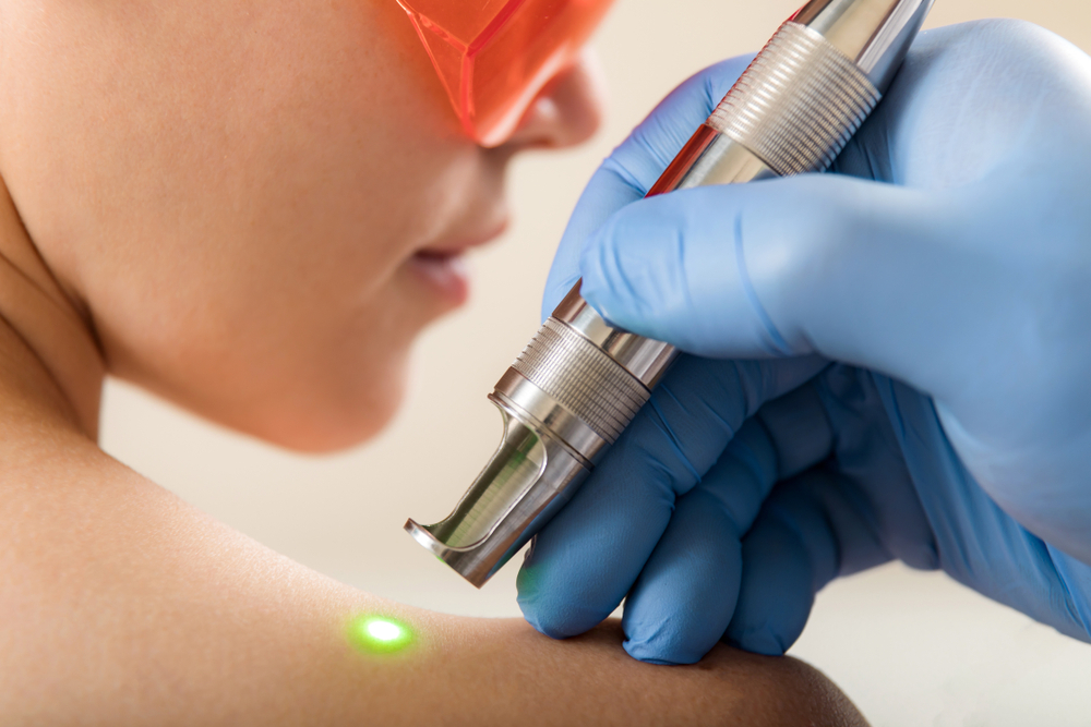 Láser para verrugas genitales